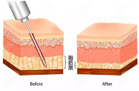 抽脂手術(shù)對身體有什么傷害？該不該禁止抽脂手術(shù)？